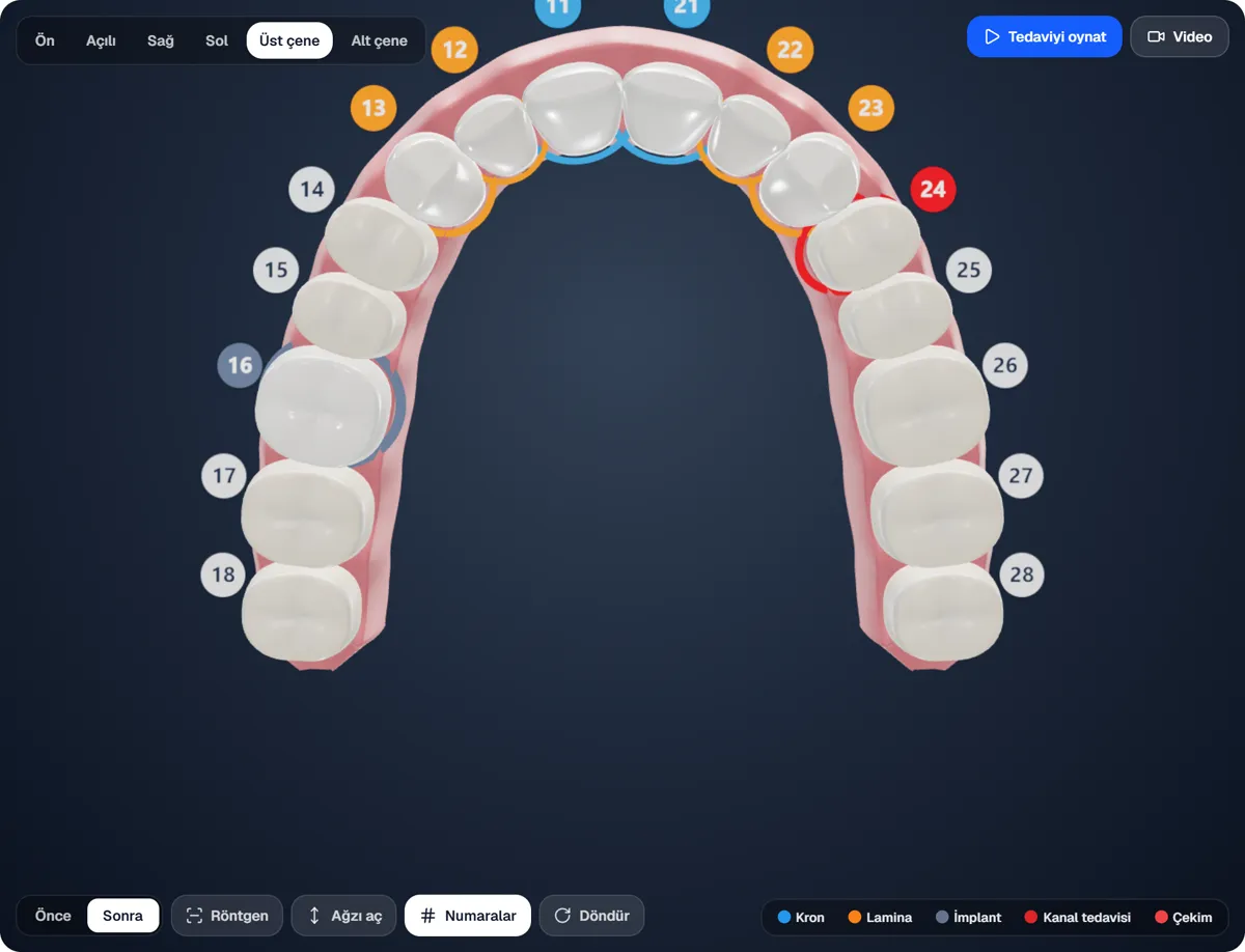 Upper arch from the biting side with coloured tooth numbers
