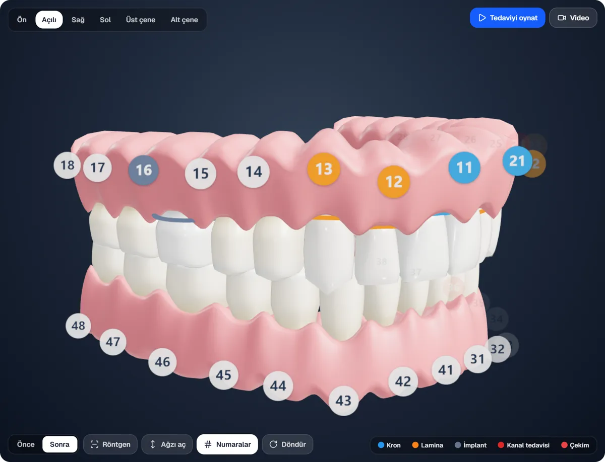 Zirconia crowns and E.max veneers on the 3D mouth