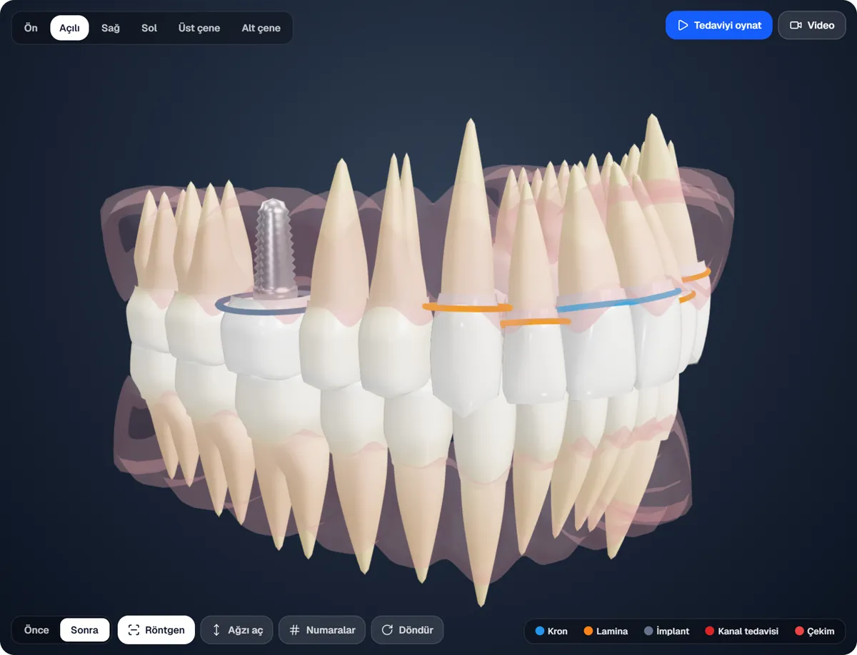Hastaya implantı anlatmayın, gösterin